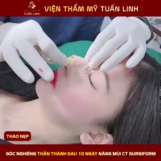 DÁNG MŨI SAU 10 NGÀY NÂNG CẤU TRÚC SURGIFORM