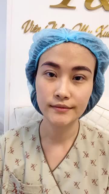 Khách hàng sử dụng combo nhấn mí + điêu khắc lông mày tại TMV Xuân Hương kết quả quá xuất sắc