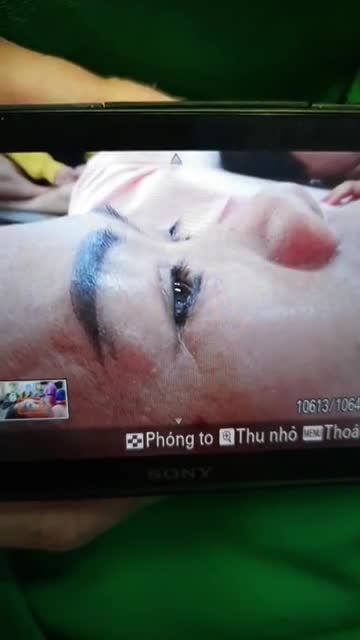 NÂNG MŨI NHÀ BS KỲ Y DƯỢC