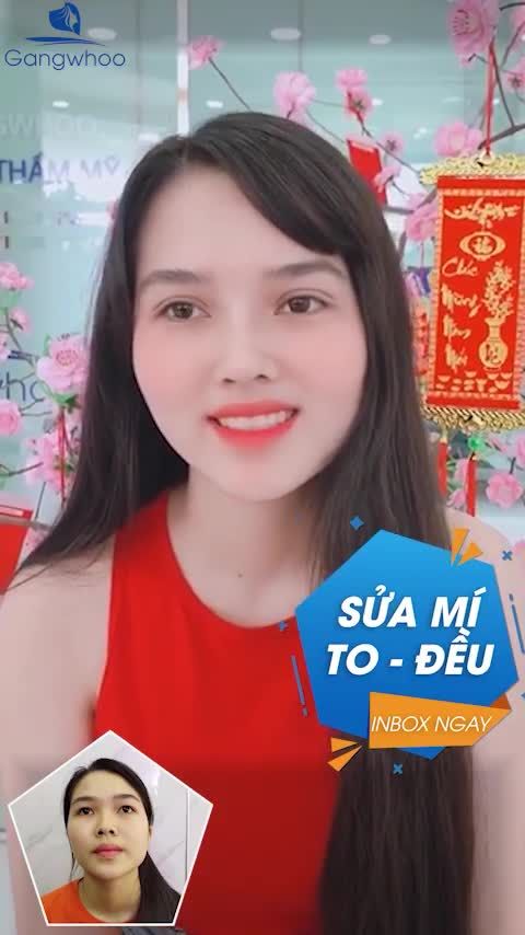 SAU KHI THỰC HIỆN COMBO BẤM MÍ VĨNH VIỄN + NÂNG MŨI CẤU TRÚC 4D - CÔ GÁI HÓA HOT GIRL THU HÚT NGƯỜI NHÌN