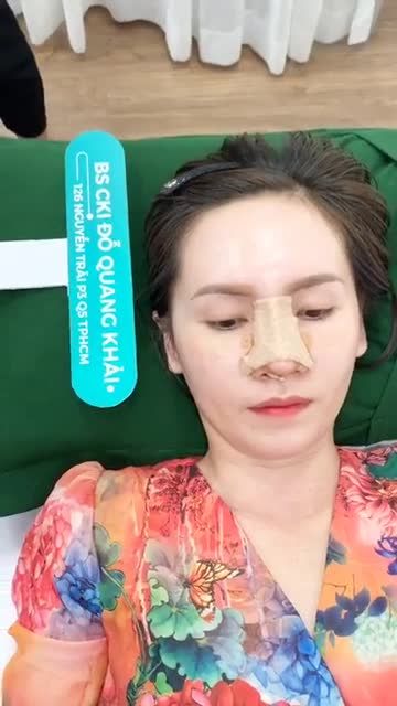TÁI KHÁM 10 NGÀY NÂNG MŨI CẤU TRÚC ĐỤC XƯƠNG BÈ CÁNH MŨI!