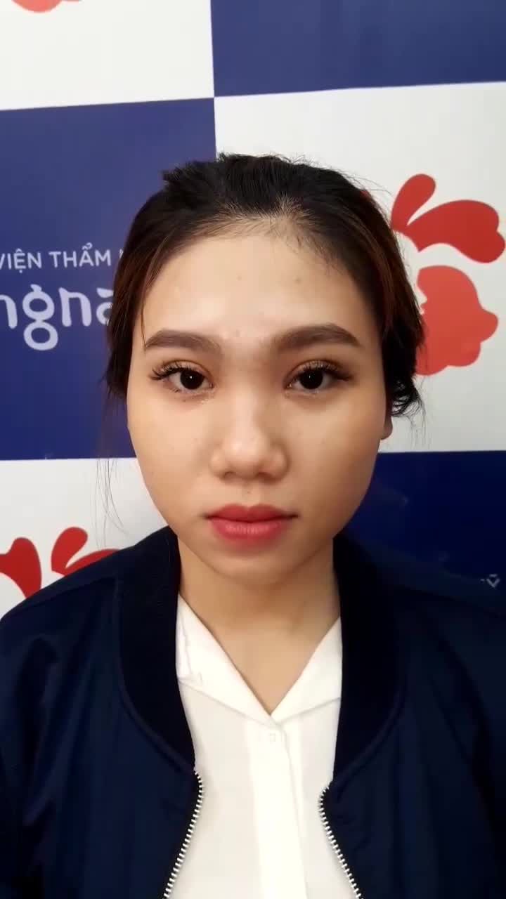 Say đắm với đôi mắt 2 mí sau 10 ngày cắt mí Plasma tại Kangnam