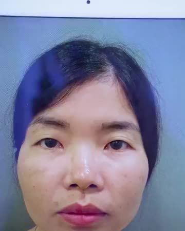 Bạn có nhận ra đó là một người chỉ có khác mỗi đôi mắt Cùng theo dõi sự thay đổi ngoạn mục chỉ sau 45 phút thực hiện tiều phẫu Cắt mí của bạn khách hàng này nhé