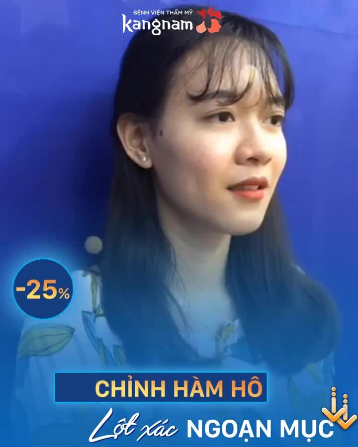 Chỉnh hàm hô Lột xác 360 độ