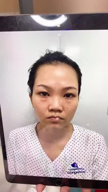 Dáng mũi NANOFROM 4D tái khám sau 1 tháng 1 chiếc mũi thay đổi PHONG THUỶ.