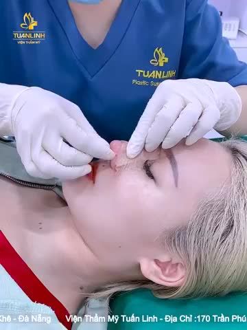 Khách hàng tái khám- tháo nẹp sau 10 ngày nâng mũi cấu trúc bọc