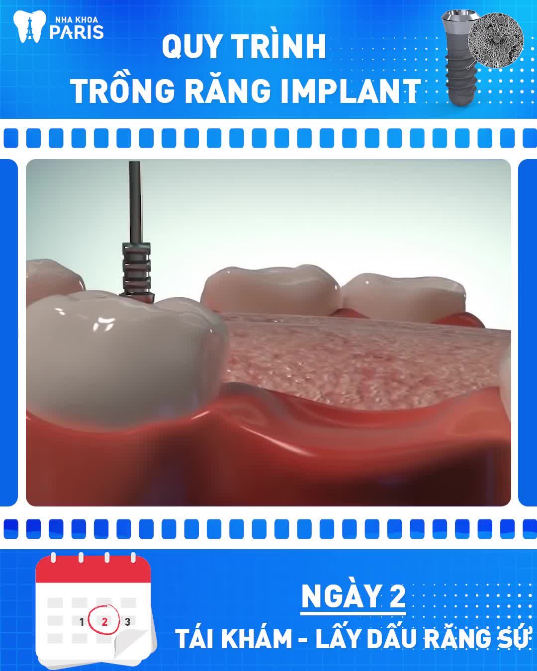 KHÔI PHỤC RĂNG MẤT AN TOÀN - BỀN CHẮC TRỌN ĐỜI