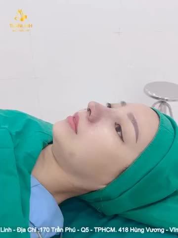 NÂNG MŨI CẤU TRÚC SAU 90 PHÚT THỰC HIỆN