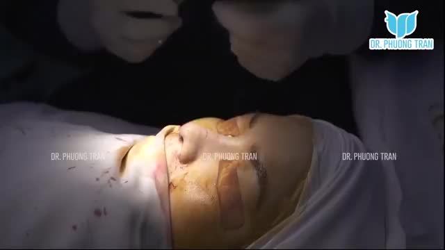 NÂNG MŨI SỤN SƯỜN TOÀN PHẦN