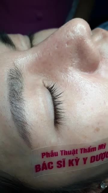 NÂNG MŨI NHÀ BS KỲ Y DƯỢC