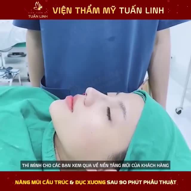 REVIEW NÂNG MŨI CẤU TRÚC  ĐỤC XƯƠNG  SAU 90P PHẪU THUẬT.