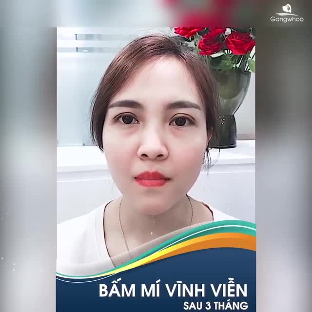BẤM MÍ VĨNH VIỄN 3 THÁNG MẮT VÀO FORM TỰ NHIÊN, KHÔNG LỘ DẤU VẾT THẨM MỸ