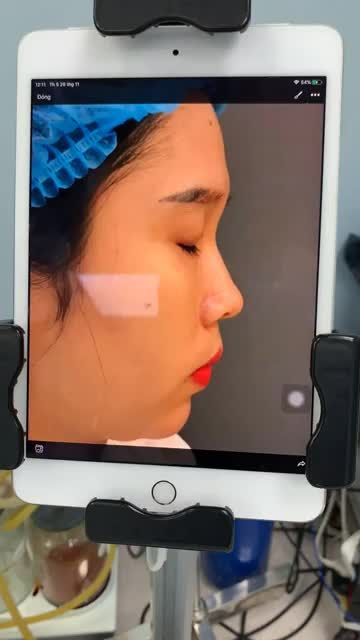 Hoàn thành ca nâng mũi thứ 2 trong ngày