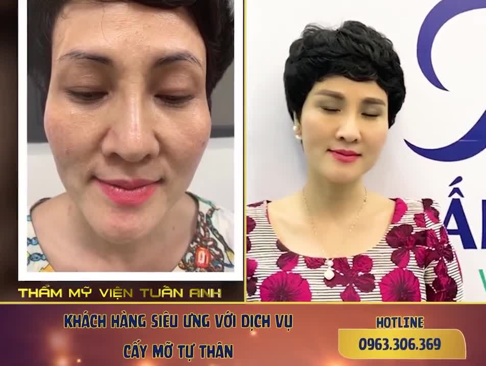 KHÁCH HÀNG SIÊU ƯNG VỚI DỊCH VỤ CẤY MỠ TẠO HÌNH KHUÔN MẶT sau 3 Tuần.