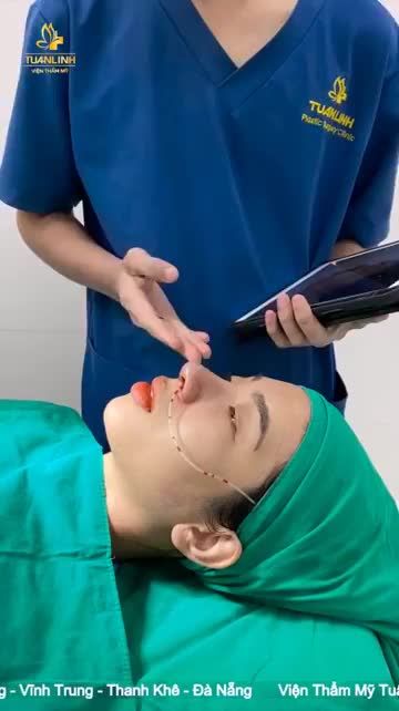 NÂNG MŨI CẤU TRÚC SAU 60 PHÚT DÁNG MŨI ANGEL LINE