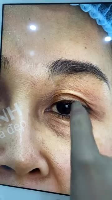 Khách hàng nâng cung chân mày + cắt mí dưới