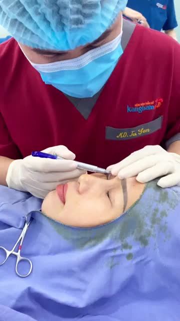 Mí chùng, rãnh lệ sâu do dấu hiệu lão hóa