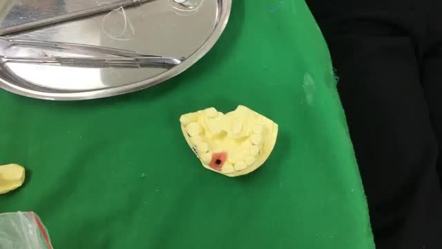 Ca gắn răng implant cho khách hàng tại Nha Khoa Thuỳ Anh.