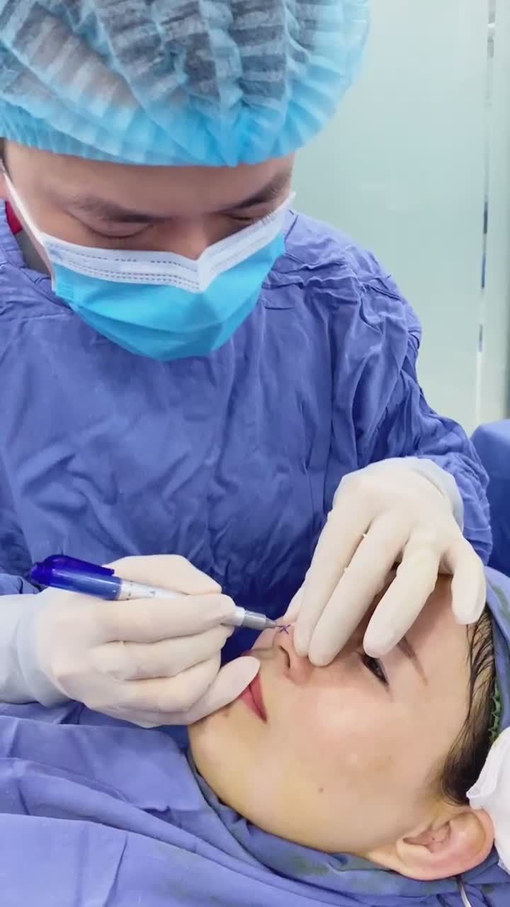 Nâng mũi cấu trúc 4D - không mê hơi khó