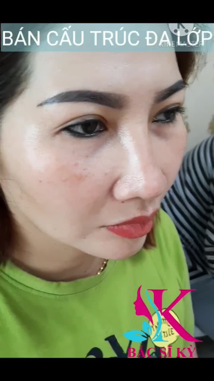 NÂNG MŨI NHÀ BS KỲ Y DƯỢC ĐẸP THANH TÚ ,HÀI HÒA VỚI KHUÔN MẶT