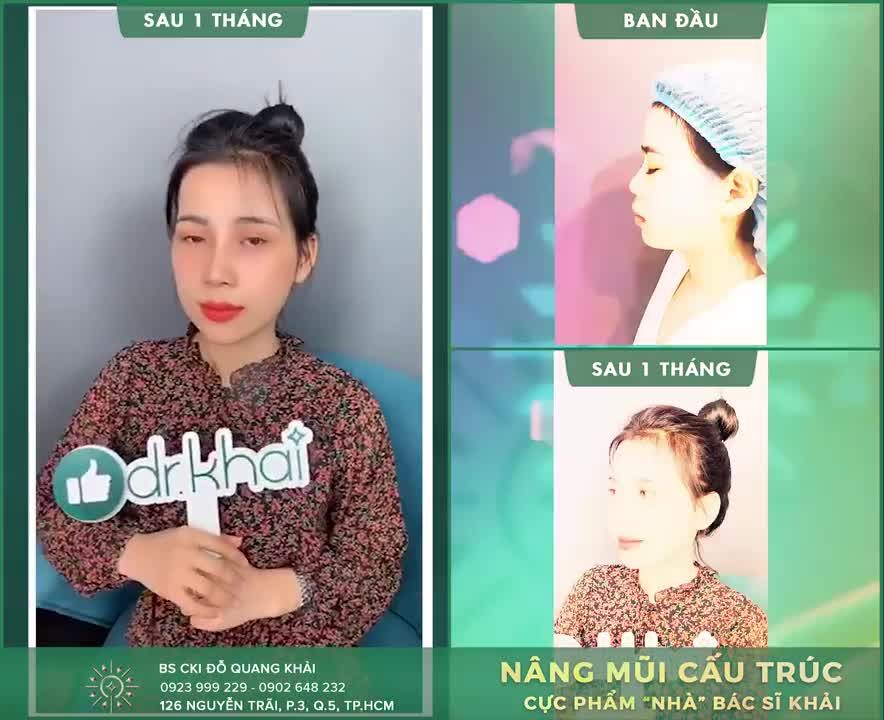 TÁI KHÁM NÂNG MŨI CẤU TRÚC SAU 1 THÁNG TẠI BÁC SĨ KHẢI!!