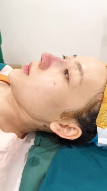 MŨI CẤU TRÚC SURGIFORM KHÔNG SƯNG KHÔNG BẦM