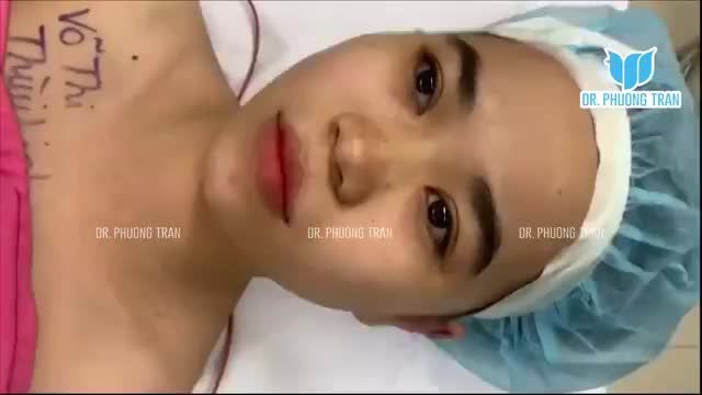 NÂNG MŨI CẤU TRÚC SỤN SƯỜN TOÀN PHẦN