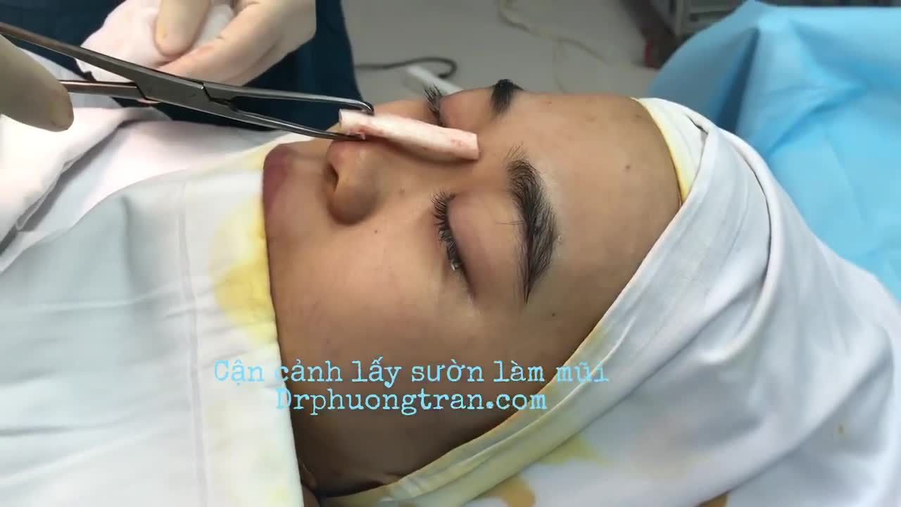 CHUẨN BỊ SƯỜN CHO QUÁ TRÌNH NÂNG MŨI SỤN SƯỜN TOÀN PHẦN.