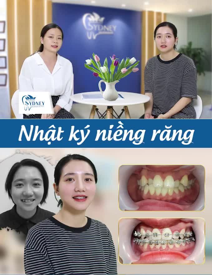 NIỀNG RĂNG MẮC CÀI KIM LOẠI HIỆU QUẢ NHƯ THẾ NÀO