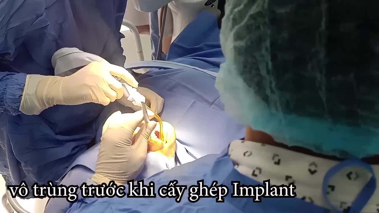 CẤY GHÉP IMPLANT ALL ON 4 - GIẢI PHÁP CHO TRƯỜNG HỢP MẤT NHIỀU RĂNG