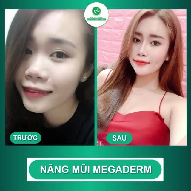 KHOE NHẸ DÁNH MŨI MEGADERM ĐƯỢC 3 NĂM TUỔI