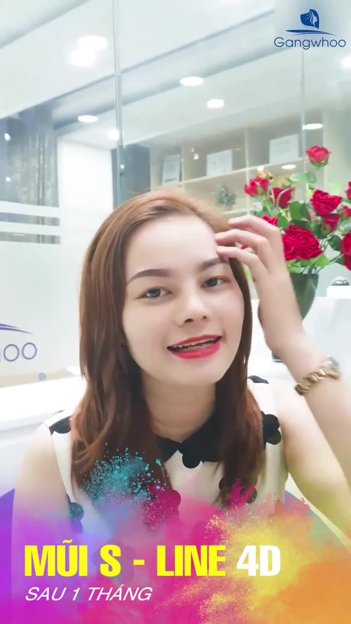 MŨI SLINE 4D sau 1 tháng vào form đẹp hoàn hảo