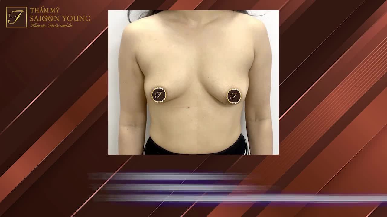 Teo tuyến vú sau sinh là tình trạng không hiếm gặp, với các nguyên nhân: