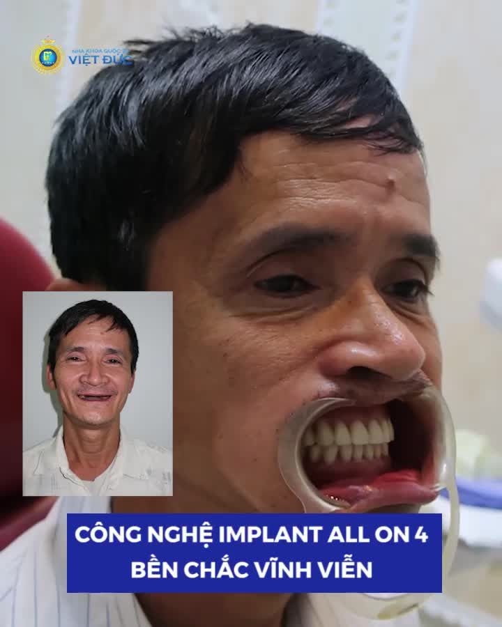 Trồng răng Implant chọn đúng địa chỉ - Răng đẹp như ý - Chi phí hợp lỳ giảm tới 15 %