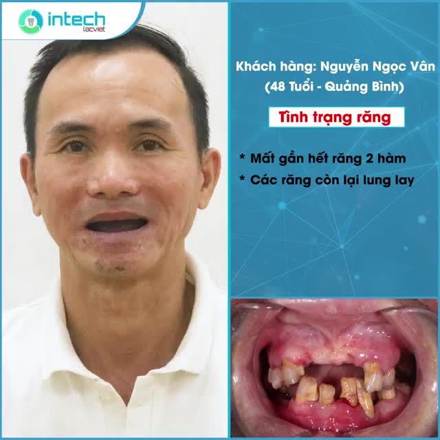 TRƯỜNG HỢP NÀO PHẢI TRỒNG IMPLANT TOÀN HÀM?
