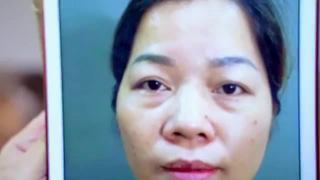 Nâng cung mày tiểu phẫu nhẹ nhàng sau 45 phút sở hứu đôi mắt đẹp rạng ngời tươi trẻ như thế nào? Mời quý khách hàng cùng theo dõi