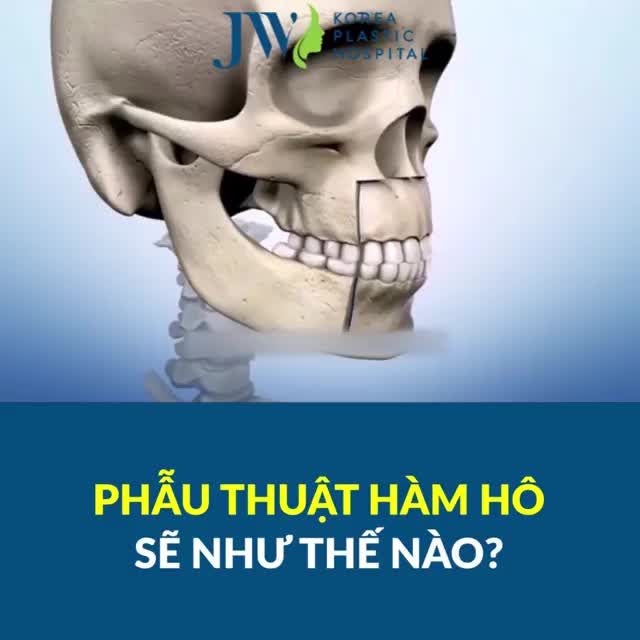 QUÁ TRÌNH PHẪU THUẬT HÀM HÔ