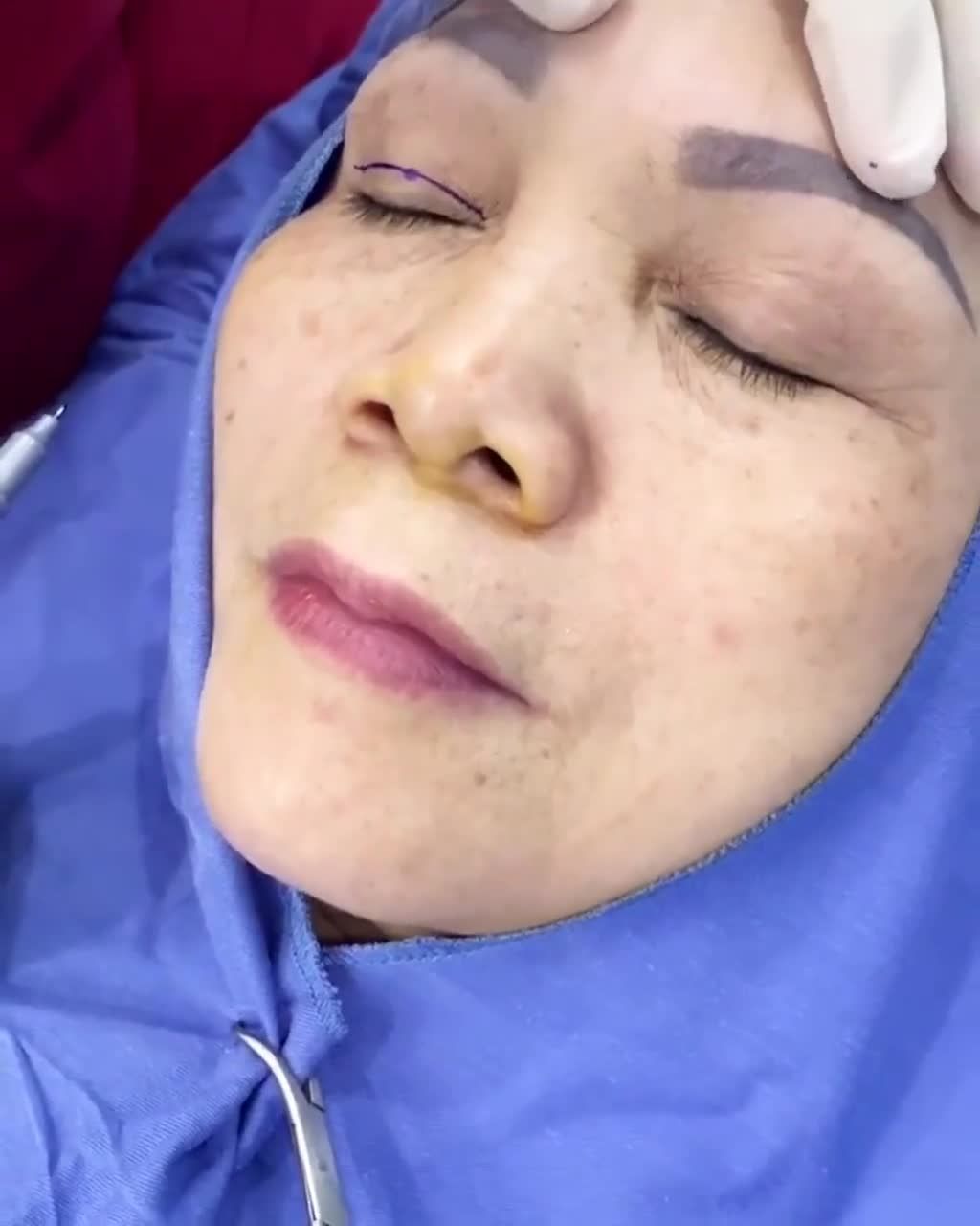 Lớn tuổi - Mí chùng - Da thừa nhăn nheo - xập xệ