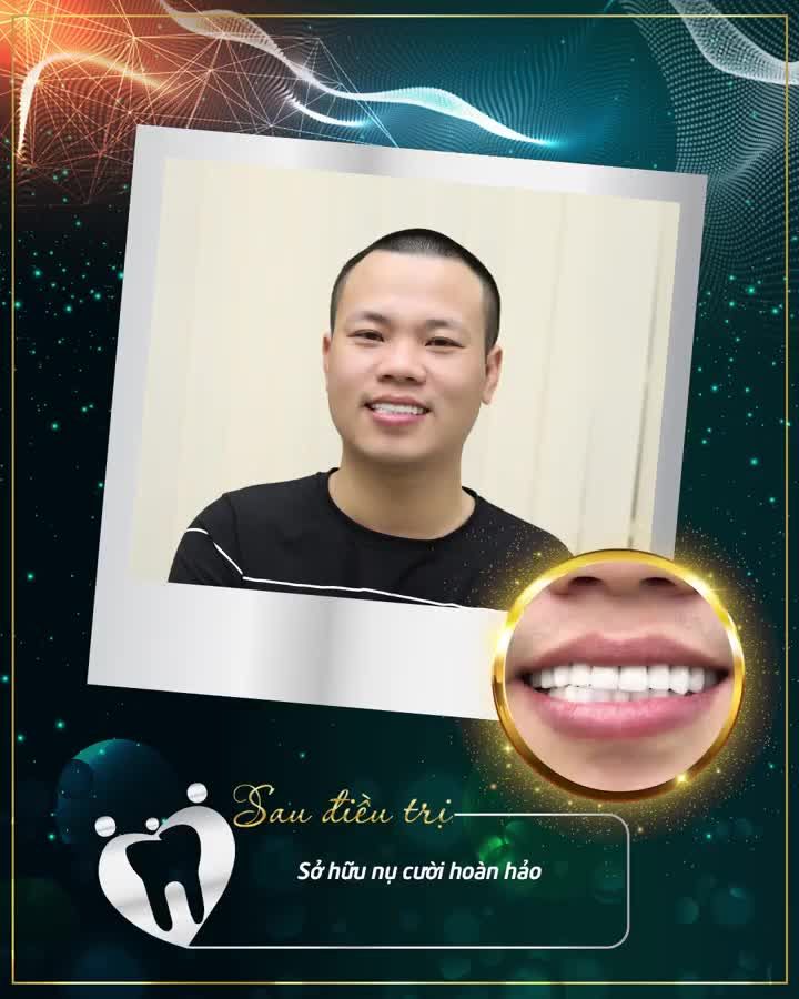 SỞ HỮU NỤ CƯỜI HOÀN MỸ SAU 2 LẦN HẸN CÙNG CHUYÊN GIA 15 NĂM KINH NGHIỆM