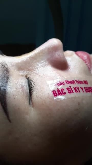 TÁI KHÁM KHÁCH HÀNG NÂNG MŨI NHÀ BS KỲ Y DƯỢC