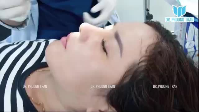 CẬN CẢNH MŨI CẤU TRÚC SỤN SƯỜN TOÀN PHẦN 12 NGÀY