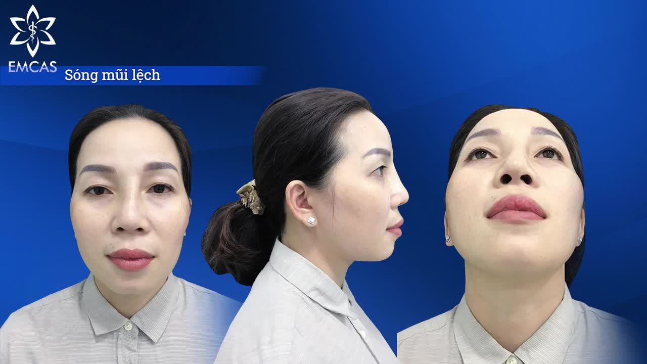 GẶP LẠI KHÁCH HÀNG SAU 1 THÁNG TÁI CẤU TRÚC MŨI LỆCH CÓ DỊCH NHIỄM TRÙNG VÀ LÀM ĐẦY THÁI DƯƠNG