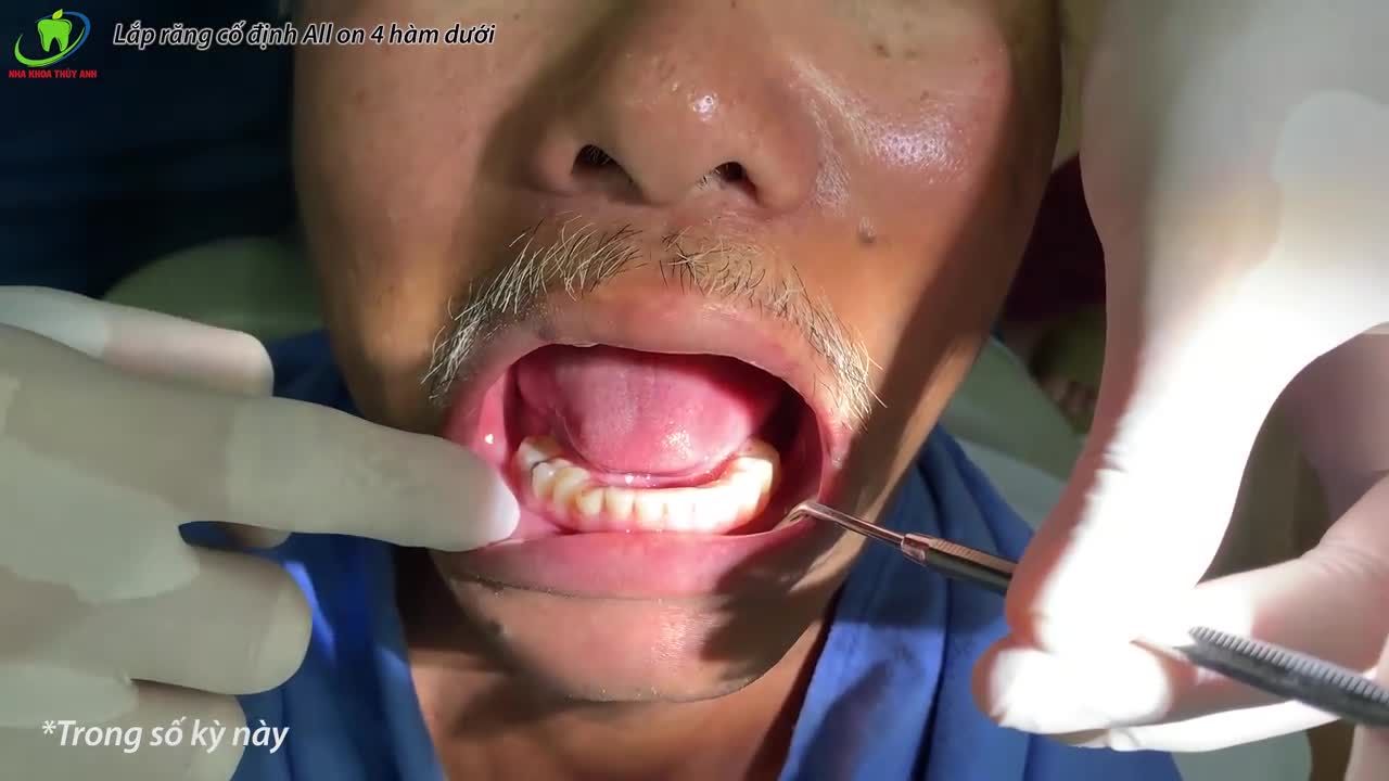 QUÁ TRÌNH LẮP RĂNG ALL ON 4 - HOÀN THIỆN HÀM RĂNG ĂN NHAI CHẮC KHỎE.