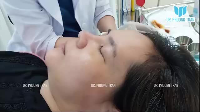 MŨI CẤU TRÚC SURGIFORM 2 TUẦN TUỔI