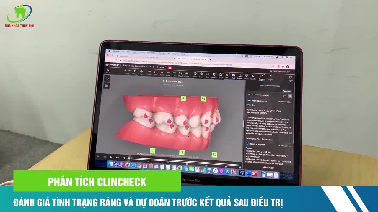 QUYẾT ĐỊNH LẠI ĐỂ LỰA CHỌN NIỀNG RĂNG BẰNG KHAY INVISALIGN.