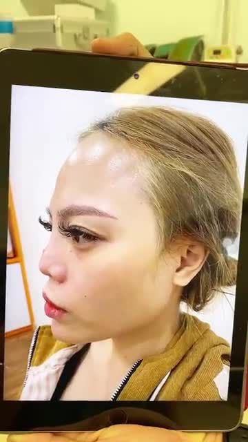 Tái tạo mũi hỏng cho khách hàng từng sửa 4 lần trước đó