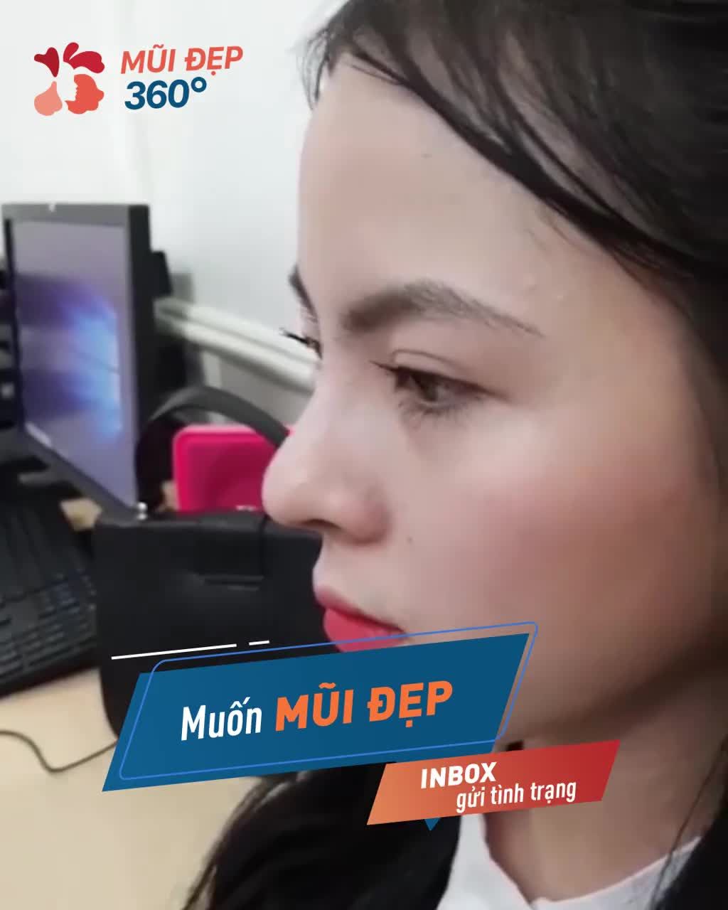 Chia tay MŨI THẤP XẤU - Có ngay MŨI ĐẸP XINH chỉ 60P