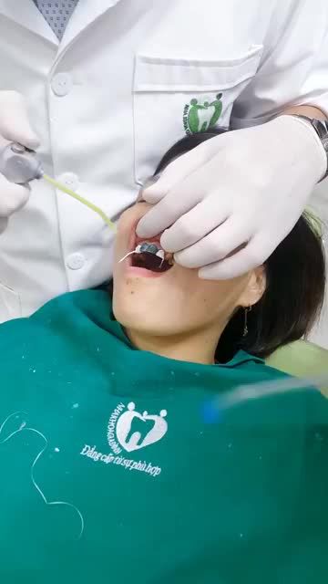 DÁN SỨ VENEER CHO MỘT CASE KH CÓ HÀM RĂNG NHIỄM MÀU KHÁNG SINH
