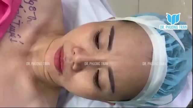 NÂNG MŨI SỤN SƯỜN TOÀN PHẦN