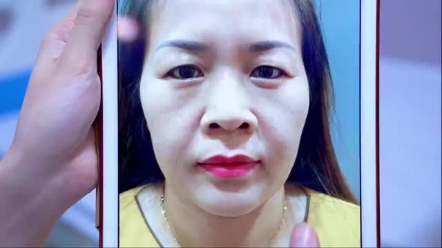 Trẻ ra từ 5-10 tuổi sau combo Nâng cung mày + Cắt mí mời quý khách hàng cùng chiêm ngưỡng.
